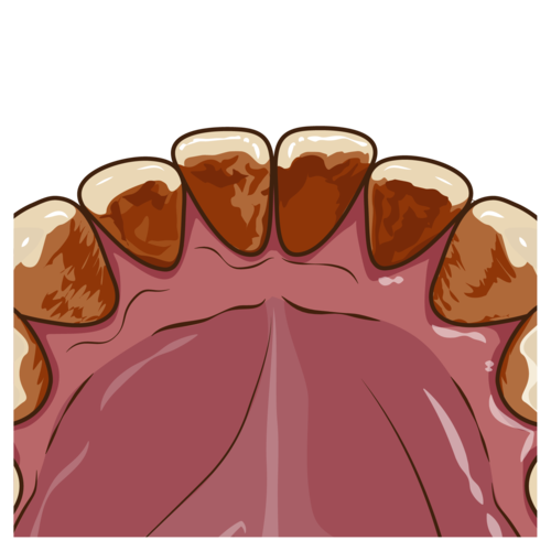 クリーニングとホワイトニングはどう違う？