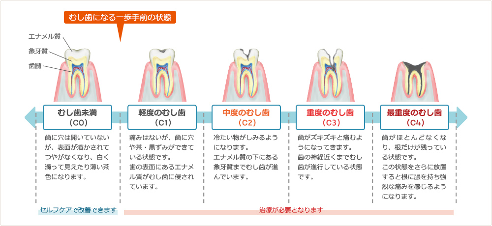 むし歯の進行