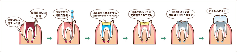 根管治療の流れ