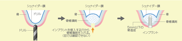ソケットリフト 骨の厚みがわずかに不足している場合に行う骨造成法