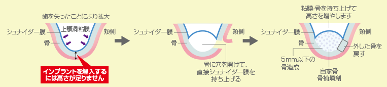 サイナスリフト 骨の不足が大きい場合に行う