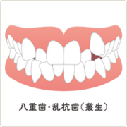 八重歯・欄工場