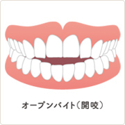 オープンバイト　開咬