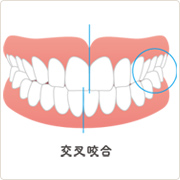 交叉咬合