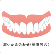 深いかみ合わせ