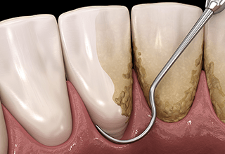 スケーリング・ルート・プレーニングのイラスト