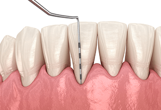 プロービングのイラスト
