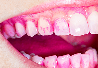 歯垢の染め出しの写真