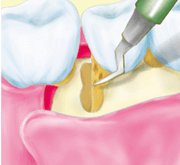 ③歯根についた汚れを除去のイラスト