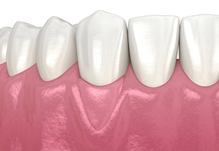 歯肉退縮治療の治療後のイラスト