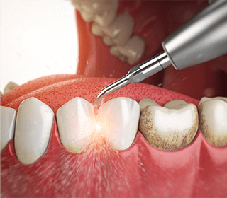 歯垢・歯石を除去のイメージイラスト