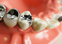 メタルインレー