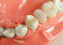 セラミックインレー