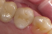 セラミックインレーの治療後