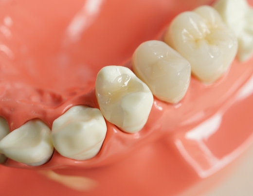 オールセラミッククラウン（ジルコニア）