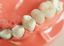 オールセラミッククラウン（ジルコニア）