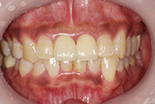 オールセラミッククラウン（ジルコニア）の治療後