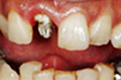 ピュアパールクラウンの治療前