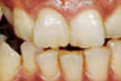 ピュアパールクラウンの治療後