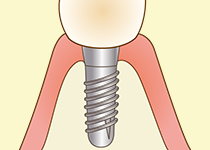 型取り・被せ物の装着（セラミッククラウン）
