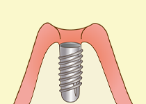 インプラント手術（1回目）