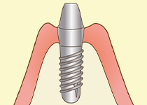 インプラント手術（2回目）