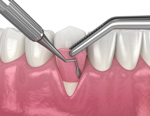 歯周病外科治療（歯周病の結合組織移植術）