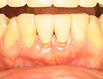 歯周病外科治療 症例1の治療後