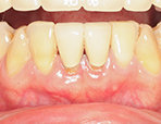 歯周病外科治療 症例1の治療後