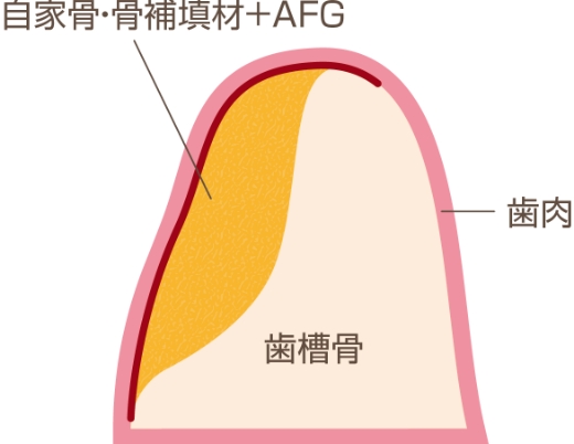 エムドゲイン（歯周組織再生治療）