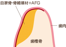 エムドゲイン（歯周組織再生治療）