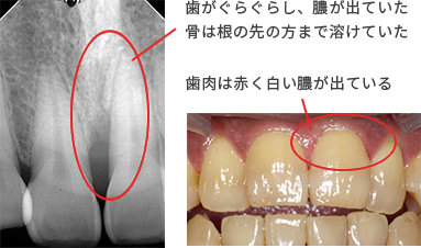 エムドゲイン 症例1の治療前