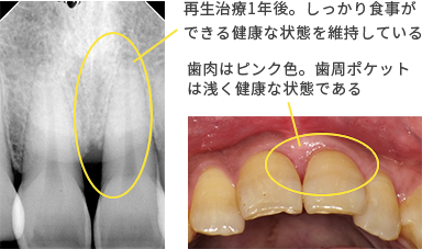 エムドゲイン 症例1の治療後