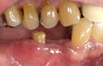 歯冠長延長術・歯肉弁根尖側移動術 症例1の治療中