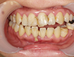 予防歯科 症例1の治療前