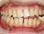 予防歯科 症例1の治療後