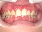 予防歯科 症例2の治療前