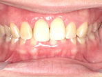 予防歯科 症例2の治療後
