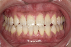 ホームホワイトニング治療前
