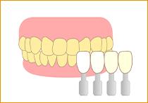 STEP.1歯の色合わせのイラスト