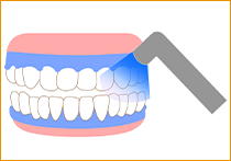 STEP.3ホワイトニング中のイラスト
