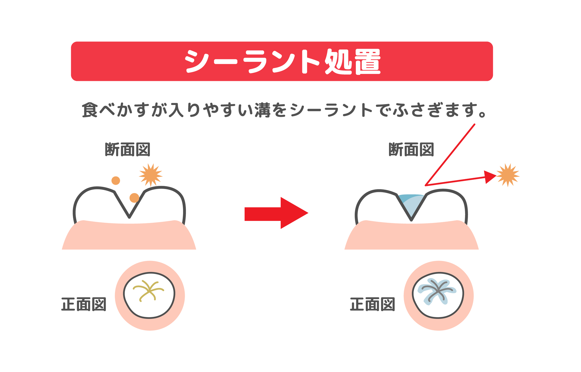 セラミック治療とは