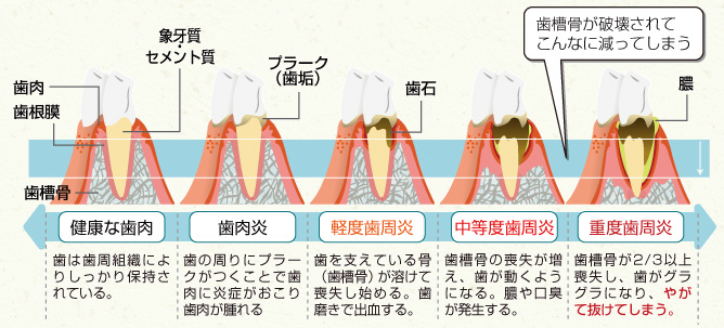 セルフチェックが重要な歯周病