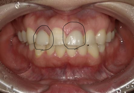 歯茎のライン 歯の大きさを揃える治療 ひまわり歯科クリニック