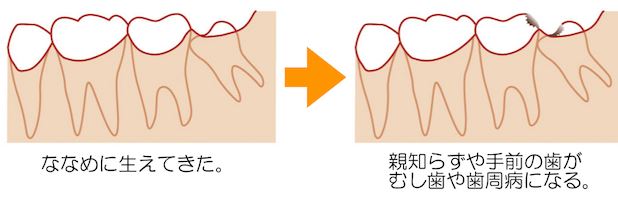 Images of 乳歯 - JapaneseClass.jp