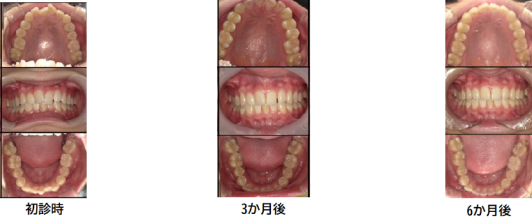 成人矯正症例②