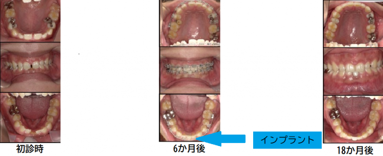 成人矯正症例④