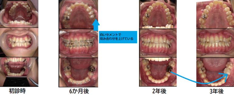 成人矯正症例⑤