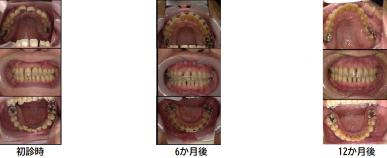 成人矯正症例③