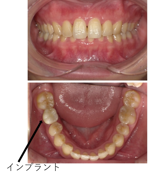 インプラント術後